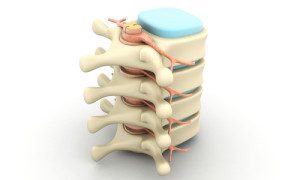 Our personal injury lawyers in Florida can help with a Facet joint injury due to the negligence of another