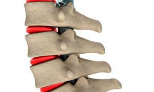 Our personal injury attorneys in Tampa can help with Lumbar herniated disc due to the negligence of another
