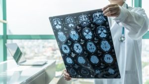 brain injury lawyer